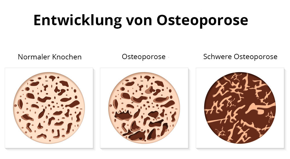 Entwicklung von Osteoporose in Bildern